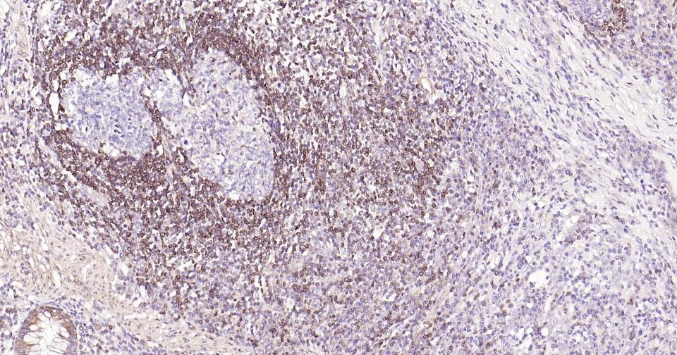 Bcl-2重组兔单抗