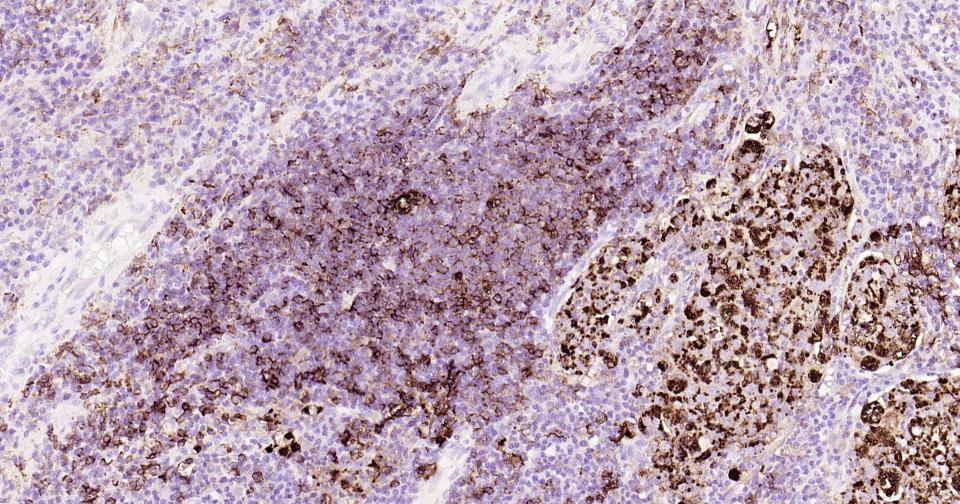 HLA-DR重组兔单抗