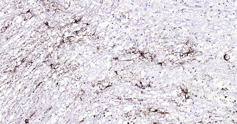 胶质纤维酸性蛋白重组兔单抗