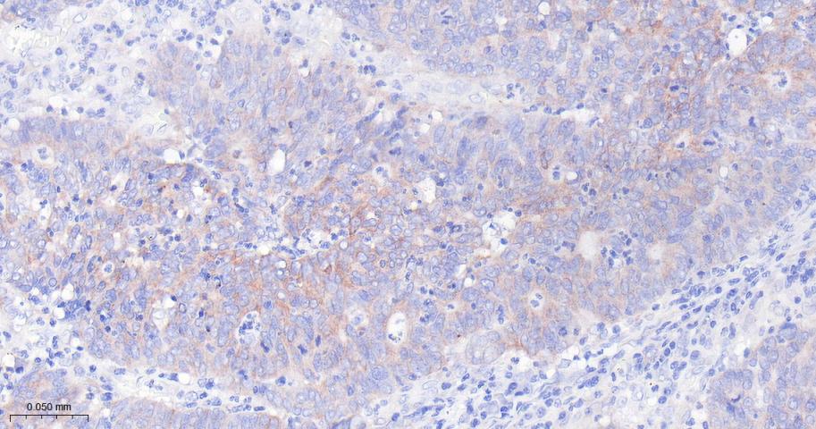 胰岛素样生长因子ⅡmRNA结合蛋白2重组兔单抗