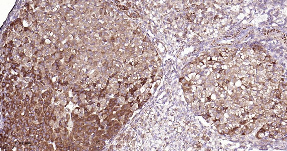 铬细胞瘤患者抑癌基因SDHB重组兔单抗