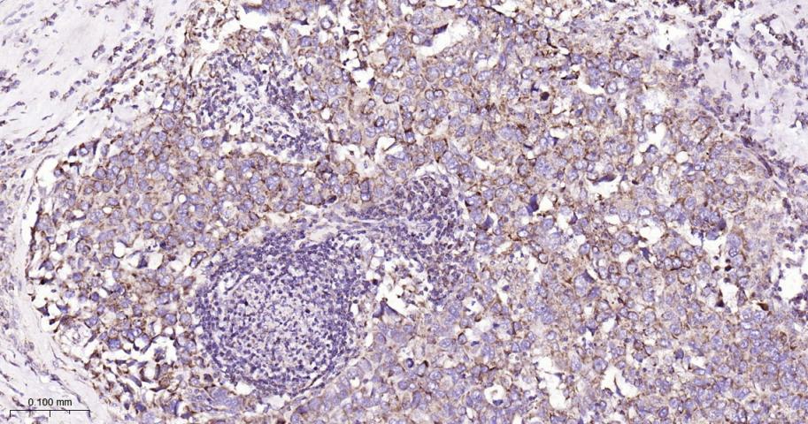 铬细胞瘤患者抑癌基因SDHB重组兔单抗