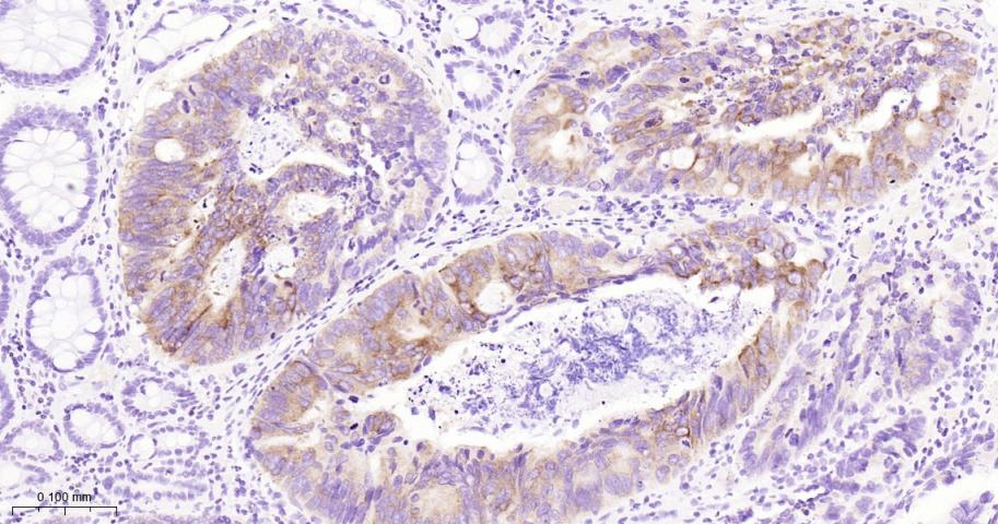 胰岛素样生长因子2mRNA结合蛋白3重组兔单抗