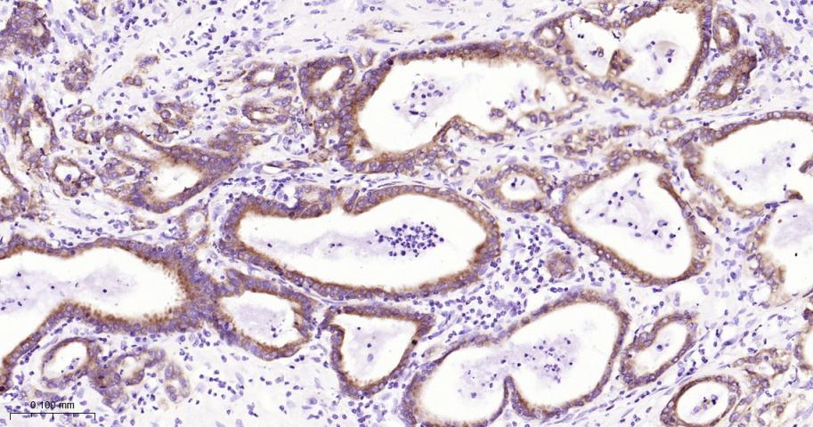 胰岛素样生长因子2mRNA结合蛋白3重组兔单抗