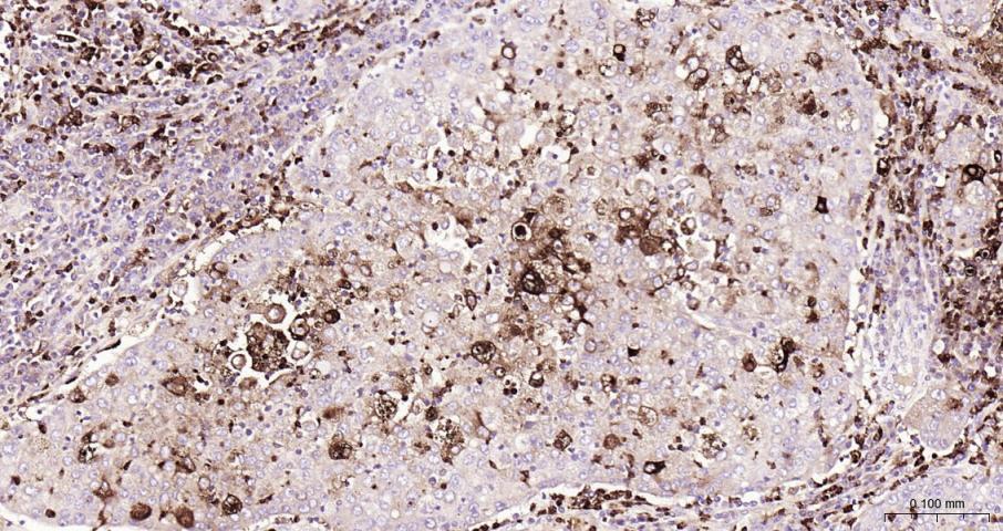 癌胚抗原重组兔单抗