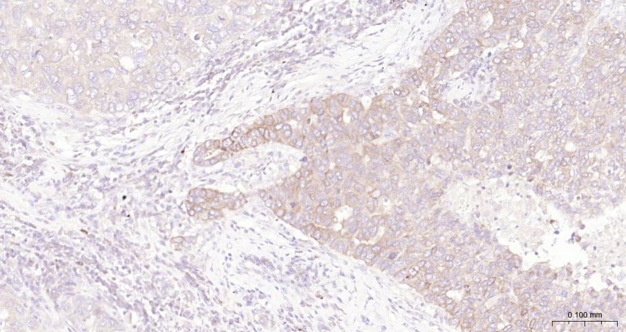 Bcl-2重组兔单抗