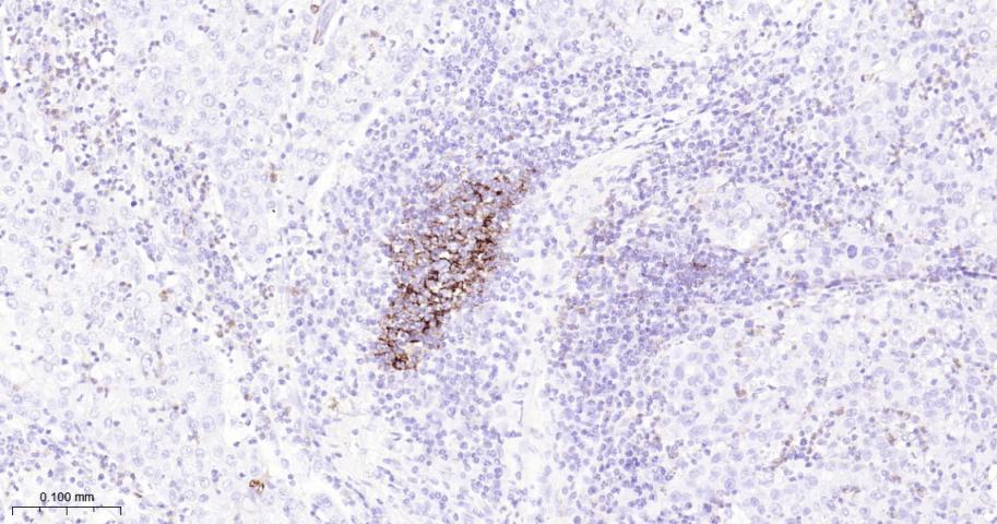 Ⅰ型补体受体重组兔单抗