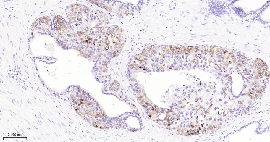 肿瘤相关胰蛋白酶抑制剂1重组兔单抗