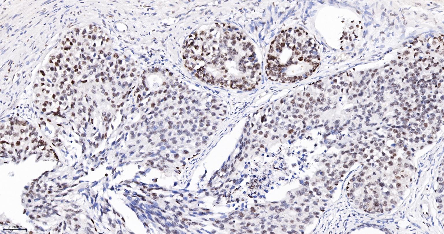 高迁移率族蛋白A1重组兔单抗