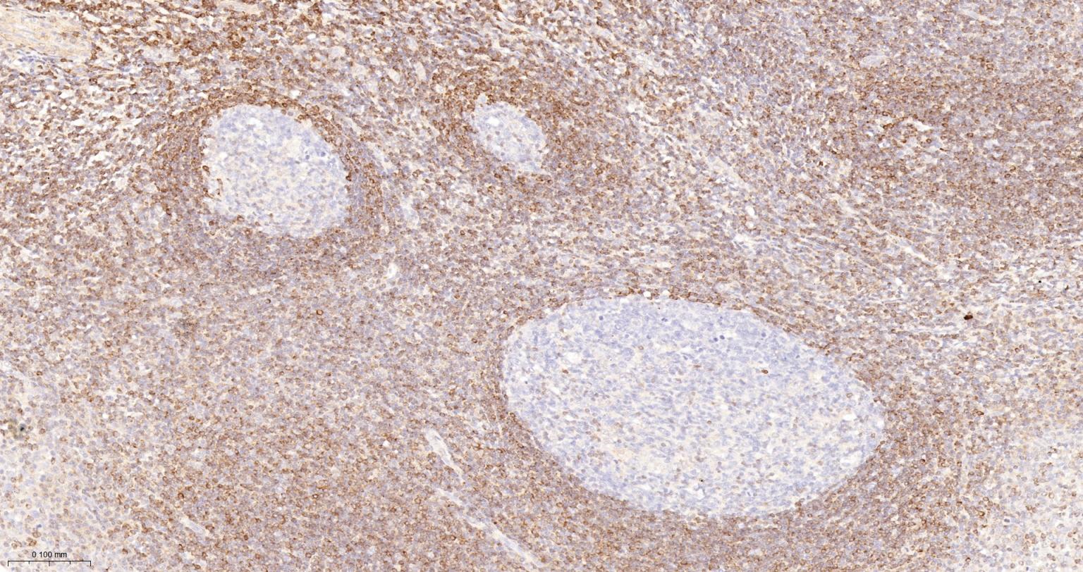 Bcl-2重组兔单抗