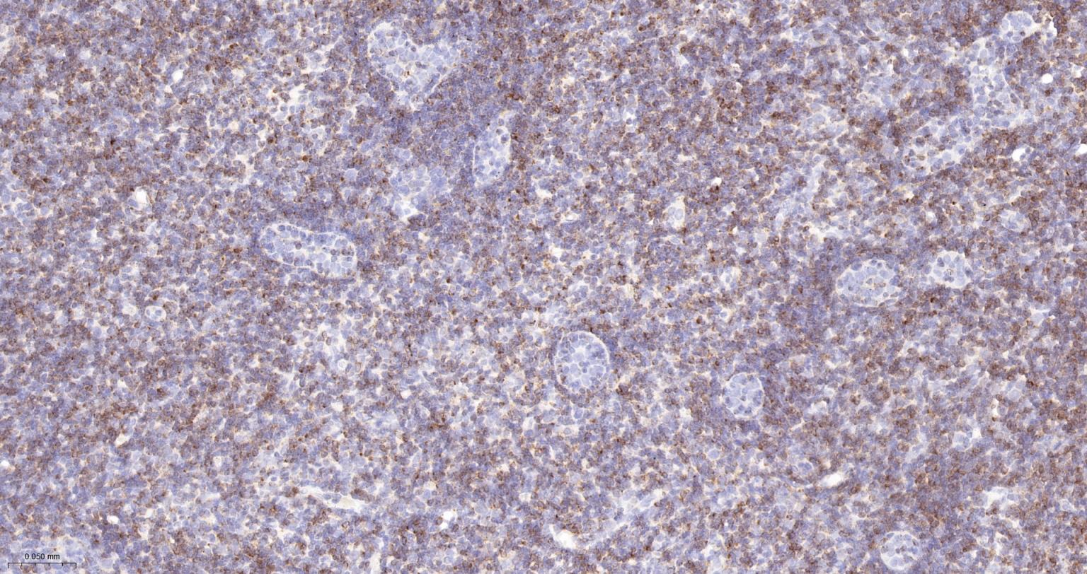 Bcl-2重组兔单抗