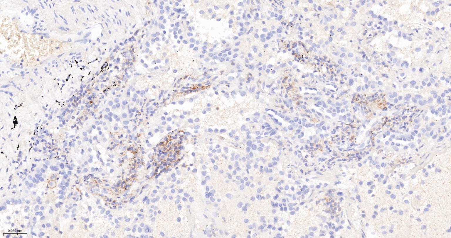 P选择素糖蛋白配体1重组兔单抗