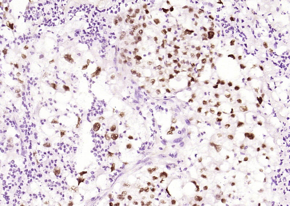 磷酸化热休克因子1重组兔单抗
